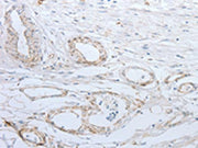 The image on the left is immunohistochemistry of paraffin-embedded Human esophagus cancer tissue using CSB-PA050912(SLC5A5 Antibody) at dilution 1/25, on the right is treated with synthetic peptide. (Original magnification: ×200)