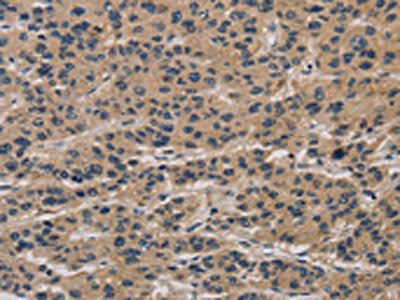 The image on the left is immunohistochemistry of paraffin-embedded Human liver cancer tissue using CSB-PA050929(CLEC2A Antibody) at dilution 1/20, on the right is treated with synthetic peptide. (Original magnification: ×200)