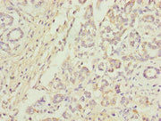 Immunohistochemistry of paraffin-embedded human pancreatic cancer using CSB-PA05104A0Rb at dilution of 1:100