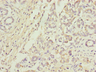 Immunohistochemistry of paraffin-embedded human pancreatic cancer using CSB-PA05104A0Rb at dilution of 1:100
