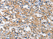 The image is immunohistochemistry of paraffin-embedded human thyroid cancer tissue using CSB-PA051064(CUL7 Antibody) at dilution 1/35. (Original magnification: ×200)