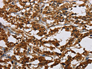 The image on the left is immunohistochemistry of paraffin-embedded Human thyroid cancer tissue using CSB-PA051134(CLDN2 Antibody) at dilution 1/30, on the right is treated with synthetic peptide. (Original magnification: ×200)