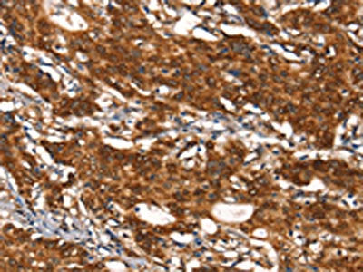 The image on the left is immunohistochemistry of paraffin-embedded Human gastic cancer tissue using CSB-PA051152(CYP2D6 Antibody) at dilution 1/30, on the right is treated with synthetic peptide. (Original magnification: ×200)
