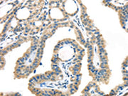 The image on the left is immunohistochemistry of paraffin-embedded Human thyroid cancer tissue using CSB-PA051160(VGF Antibody) at dilution 1/45, on the right is treated with synthetic peptide. (Original magnification: ×200)