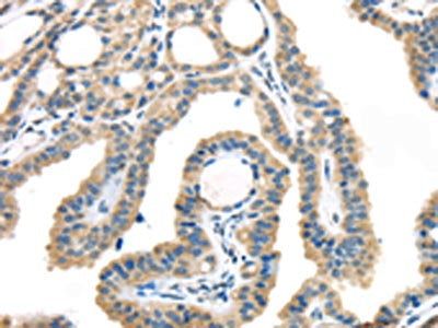 The image on the left is immunohistochemistry of paraffin-embedded Human thyroid cancer tissue using CSB-PA051160(VGF Antibody) at dilution 1/45, on the right is treated with synthetic peptide. (Original magnification: ×200)