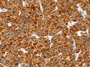 The image on the left is immunohistochemistry of paraffin-embedded Human liver cancer tissue using CSB-PA051218(MGST1 Antibody) at dilution 1/40, on the right is treated with synthetic peptide. (Original magnification: ×200)