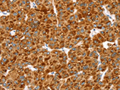 The image on the left is immunohistochemistry of paraffin-embedded Human liver cancer tissue using CSB-PA051218(MGST1 Antibody) at dilution 1/40, on the right is treated with synthetic peptide. (Original magnification: ×200)
