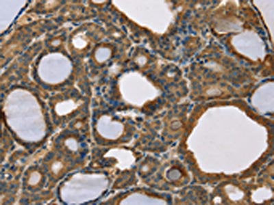 The image on the left is immunohistochemistry of paraffin-embedded Human thyroid cancer tissue using CSB-PA051247(SCGB2A1 Antibody) at dilution 1/50, on the right is treated with fusion protein. (Original magnification: ×200)