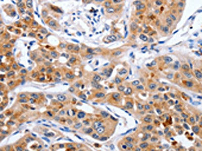The image on the left is immunohistochemistry of paraffin-embedded Human lung cancer tissue using CSB-PA051391(NCK1 Antibody) at dilution 1/30, on the right is treated with fusion protein. (Original magnification: ×200)