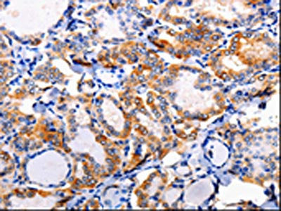 The image on the left is immunohistochemistry of paraffin-embedded Human thyroid cancer tissue using CSB-PA051525(AP1B1 Antibody) at dilution 1/100, on the right is treated with synthetic peptide. (Original magnification: ×200)