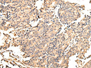 The image on the left is immunohistochemistry of paraffin-embedded Human prostate cancer tissue using CSB-PA051537(UGGT2 Antibody) at dilution 1/25, on the right is treated with fusion protein. (Original magnification: ×200)