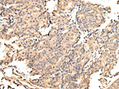 The image on the left is immunohistochemistry of paraffin-embedded Human prostate cancer tissue using CSB-PA051537(UGGT2 Antibody) at dilution 1/25, on the right is treated with fusion protein. (Original magnification: ×200)