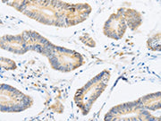 The image on the left is immunohistochemistry of paraffin-embedded Human colon cancer tissue using CSB-PA051678(ABHD1 Antibody) at dilution 1/15, on the right is treated with fusion protein. (Original magnification: ×200)