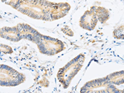The image on the left is immunohistochemistry of paraffin-embedded Human colon cancer tissue using CSB-PA051678(ABHD1 Antibody) at dilution 1/15, on the right is treated with fusion protein. (Original magnification: ×200)