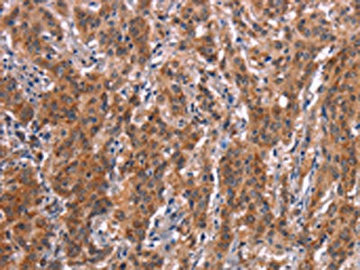 The image on the left is immunohistochemistry of paraffin-embedded Human gastic cancer tissue using CSB-PA051790(FDCSP Antibody) at dilution 1/25, on the right is treated with synthetic peptide. (Original magnification: ×200)