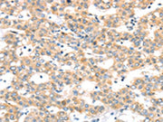 The image on the left is immunohistochemistry of paraffin-embedded Human breast cancer tissue using CSB-PA051869(RAB24 Antibody) at dilution 1/45, on the right is treated with synthetic peptide. (Original magnification: ×200)