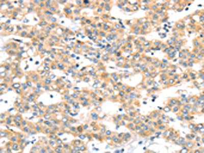 The image on the left is immunohistochemistry of paraffin-embedded Human breast cancer tissue using CSB-PA051869(RAB24 Antibody) at dilution 1/45, on the right is treated with synthetic peptide. (Original magnification: ×200)