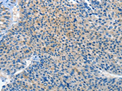 The image on the left is immunohistochemistry of paraffin-embedded Human liver cancer tissue using CSB-PA051875(PRKX Antibody) at dilution 1/20, on the right is treated with synthetic peptide. (Original magnification: ×200)