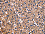 The image on the left is immunohistochemistry of paraffin-embedded Human liver cancer tissue using CSB-PA051887(ADM2 Antibody) at dilution 1/40, on the right is treated with synthetic peptide. (Original magnification: ×200)