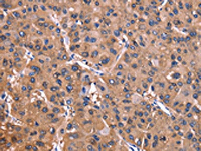 The image on the left is immunohistochemistry of paraffin-embedded Human liver cancer tissue using CSB-PA051887(ADM2 Antibody) at dilution 1/40, on the right is treated with synthetic peptide. (Original magnification: ×200)