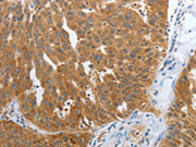 The image on the left is immunohistochemistry of paraffin-embedded Human ovarian cancer tissue using CSB-PA052191(NPY1R Antibody) at dilution 1/25, on the right is treated with synthetic peptide. (Original magnification: ×200)