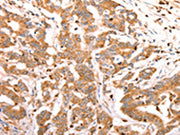 The image on the left is immunohistochemistry of paraffin-embedded Human colon cancer tissue using CSB-PA052305(CELSR2 Antibody) at dilution 1/50, on the right is treated with synthetic peptide. (Original magnification: ×200)