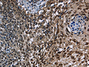 The image on the left is immunohistochemistry of paraffin-embedded Human cervical cancer tissue using CSB-PA052445(KDM3B Antibody) at dilution 1/40, on the right is treated with fusion protein. (Original magnification: ×200)