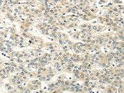 The image on the left is immunohistochemistry of paraffin-embedded Human liver cancer tissue using CSB-PA052529(VIPR1 Antibody) at dilution 1/20, on the right is treated with synthetic peptide. (Original magnification: ×200)