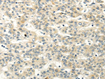 The image on the left is immunohistochemistry of paraffin-embedded Human liver cancer tissue using CSB-PA052529(VIPR1 Antibody) at dilution 1/20, on the right is treated with synthetic peptide. (Original magnification: ×200)
