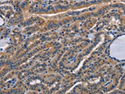 The image on the left is immunohistochemistry of paraffin-embedded Human thyroid cancer tissue using CSB-PA052910(STRADB Antibody) at dilution 1/15, on the right is treated with fusion protein. (Original magnification: ×200)