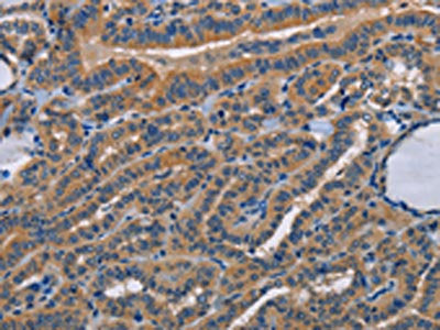 The image on the left is immunohistochemistry of paraffin-embedded Human thyroid cancer tissue using CSB-PA052910(STRADB Antibody) at dilution 1/15, on the right is treated with fusion protein. (Original magnification: ×200)