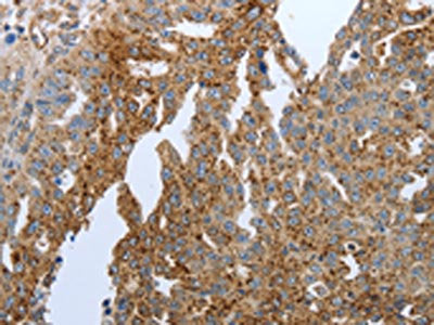 The image on the left is immunohistochemistry of paraffin-embedded Human ovarian cancer tissue using CSB-PA053064(PPARG Antibody) at dilution 1/20, on the right is treated with synthetic peptide. (Original magnification: ×200)
