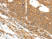 The image on the left is immunohistochemistry of paraffin-embedded Human liver cancer tissue using CSB-PA053077(DOPEY1 Antibody) at dilution 1/25, on the right is treated with synthetic peptide. (Original magnification: ×200)