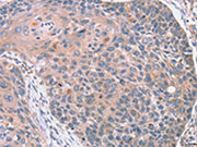The image on the left is immunohistochemistry of paraffin-embedded Human esophagus cancer tissue using CSB-PA053220(RGS10 Antibody) at dilution 1/20, on the right is treated with fusion protein. (Original magnification: ×200)