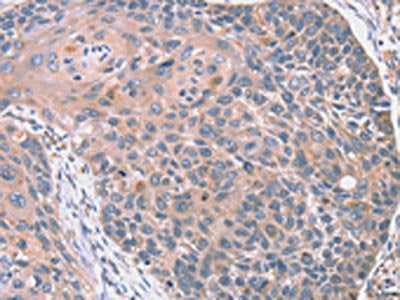 The image on the left is immunohistochemistry of paraffin-embedded Human esophagus cancer tissue using CSB-PA053220(RGS10 Antibody) at dilution 1/20, on the right is treated with fusion protein. (Original magnification: ×200)