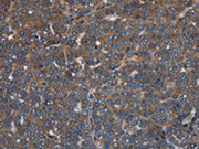 The image on the left is immunohistochemistry of paraffin-embedded Human ovarian cancer tissue using CSB-PA053347(LETMD1 Antibody) at dilution 1/30, on the right is treated with fusion protein. (Original magnification: ×200)