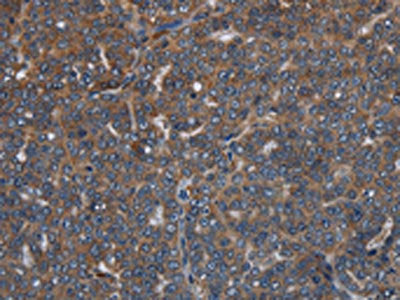 The image on the left is immunohistochemistry of paraffin-embedded Human ovarian cancer tissue using CSB-PA053347(LETMD1 Antibody) at dilution 1/30, on the right is treated with fusion protein. (Original magnification: ×200)
