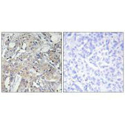 Immunohistochemistry analysis of paraffin-embedded human breast carcinoma tissue using Collagen VI α3 antibody.
