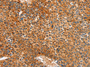 The image on the left is immunohistochemistry of paraffin-embedded Human liver cancer tissue using CSB-PA053602(ALDH1A2 Antibody) at dilution 1/30, on the right is treated with synthetic peptide. (Original magnification: ×200)