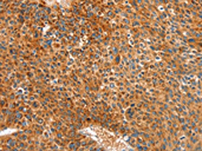 The image on the left is immunohistochemistry of paraffin-embedded Human liver cancer tissue using CSB-PA053602(ALDH1A2 Antibody) at dilution 1/30, on the right is treated with synthetic peptide. (Original magnification: ×200)