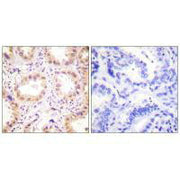Immunohistochemistry analysis of paraffin-embedded human lung carcinoma tissue using NEDD8 antibody.