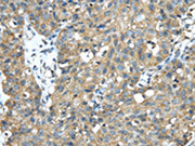 The image on the left is immunohistochemistry of paraffin-embedded Human breast cancer tissue using CSB-PA053790(TMED1 Antibody) at dilution 1/35, on the right is treated with fusion protein. (Original magnification: ×200)