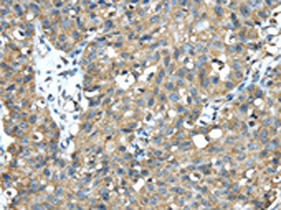 The image on the left is immunohistochemistry of paraffin-embedded Human breast cancer tissue using CSB-PA053790(TMED1 Antibody) at dilution 1/35, on the right is treated with fusion protein. (Original magnification: ×200)