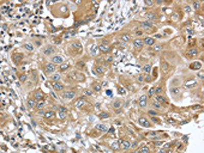 The image on the left is immunohistochemistry of paraffin-embedded Human esophagus cancer tissue using CSB-PA053884(DNAJA3 Antibody) at dilution 1/25, on the right is treated with fusion protein. (Original magnification: ×200)