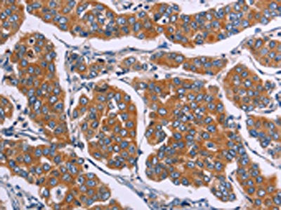 The image on the left is immunohistochemistry of paraffin-embedded Human breast cancer tissue using CSB-PA053903(FST Antibody) at dilution 1/20, on the right is treated with synthetic peptide. (Original magnification: x200)