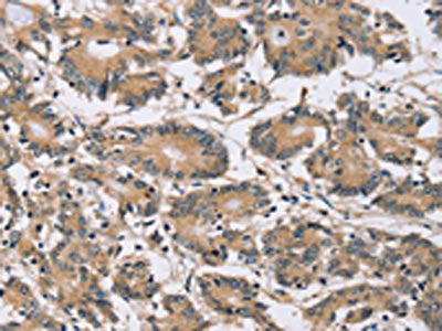 The image on the left is immunohistochemistry of paraffin-embedded Human colon cancer tissue using CSB-PA054013(PDLIM7 Antibody) at dilution 1/20, on the right is treated with fusion protein. (Original magnification: ×200)