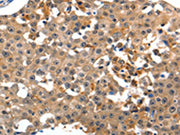 The image on the left is immunohistochemistry of paraffin-embedded Human breast cancer tissue using CSB-PA054030(GRM1 Antibody) at dilution 1/15, on the right is treated with synthetic peptide. (Original magnification: ×200)
