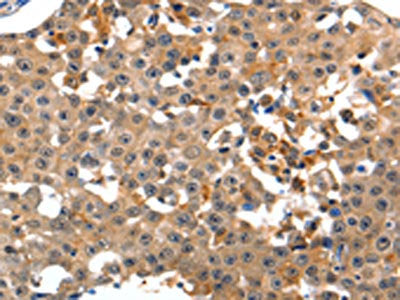 The image on the left is immunohistochemistry of paraffin-embedded Human breast cancer tissue using CSB-PA054030(GRM1 Antibody) at dilution 1/15, on the right is treated with synthetic peptide. (Original magnification: ×200)