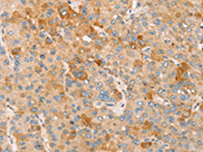 The image on the left is immunohistochemistry of paraffin-embedded Human liver cancer tissue using CSB-PA054075(TRIM25 Antibody) at dilution 1/25, on the right is treated with synthetic peptide. (Original magnification: ×200)