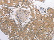 The image on the left is immunohistochemistry of paraffin-embedded Human breast cancer tissue using CSB-PA054080(PGA3/PGA4/PGA5 Antibody) at dilution 1/40, on the right is treated with synthetic peptide. (Original magnification: ×200)